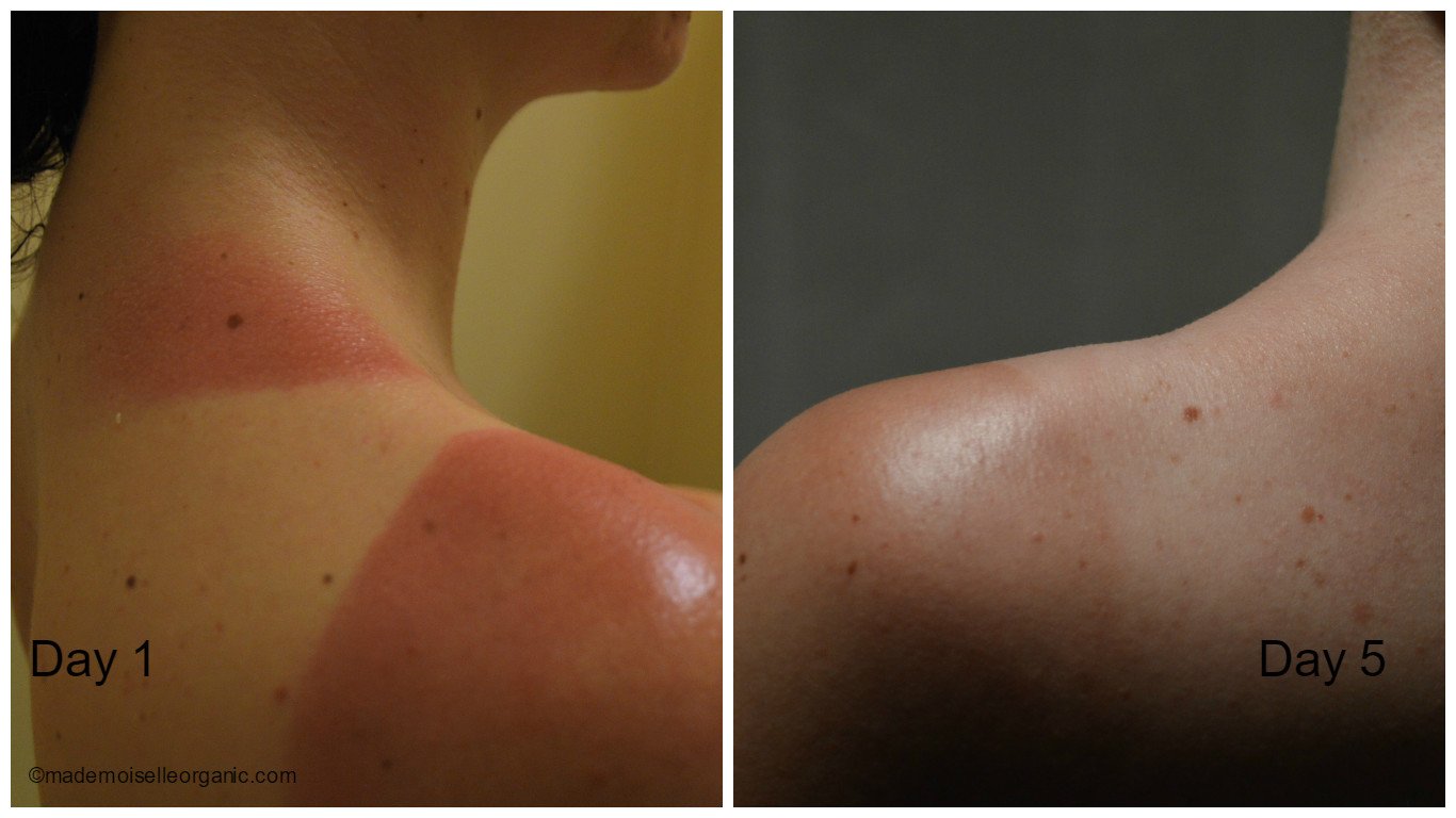 sunburn day 1 and day 5, after applying aloe vera gel and shea butter twice a day
